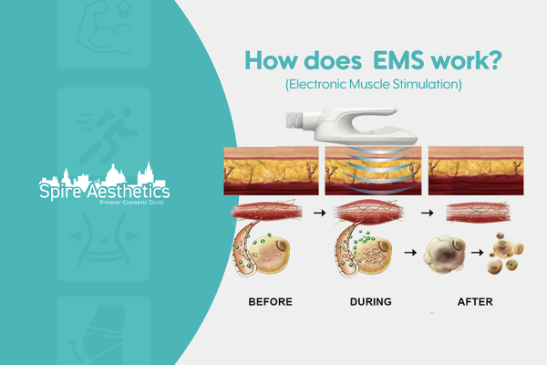 EMS treatment for post pregnancy weight loss treatment Uttoxeter