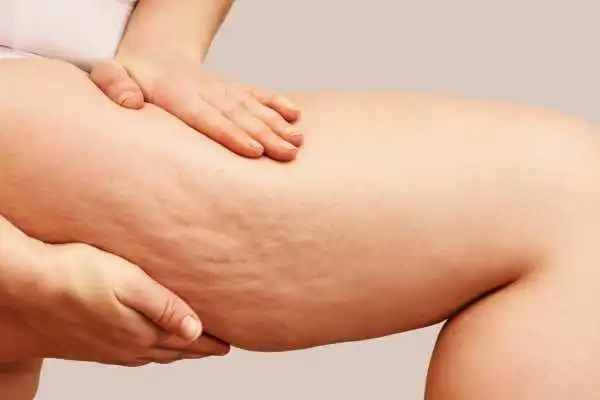Image of woman showing leg with cellulite Uttoxeter