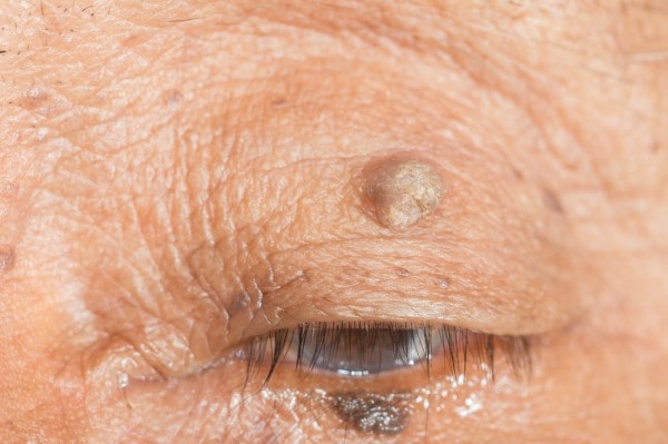 Skin imperfections Uttoxeter - Cryopen is fast and effective book in today!