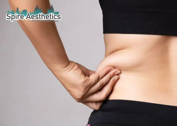Image of woman pinching fat on their hips Uttoxeter. Fat Freezing treatment