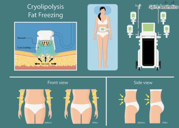 Image of diet and fat freezing combined for best results for Spire Aesthetics Uttoxeter