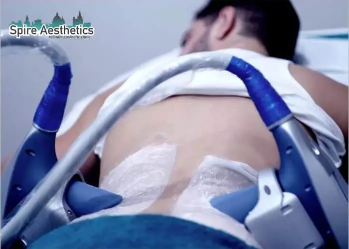 Man having fat freezing treatment done on love handles before a competitions Uttoxeter to create a sculpted look.
