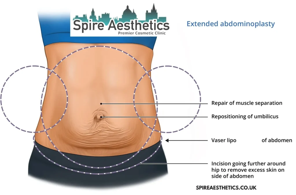 Understanding Loose Skin After Gastric Band Uttoxeter Surgery and HIFU Treatment