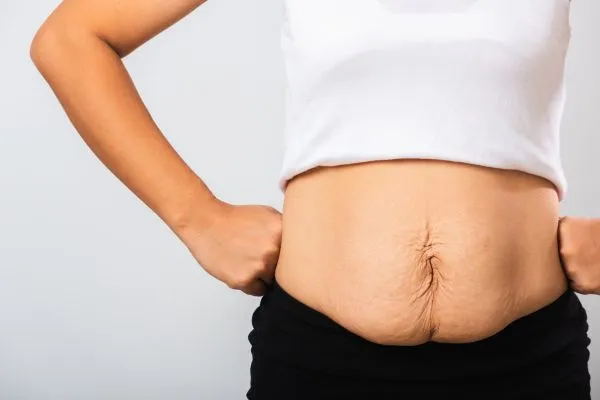 Image of a woman's stomach after weight loss with sagging skin following a gastric band Uttoxeter