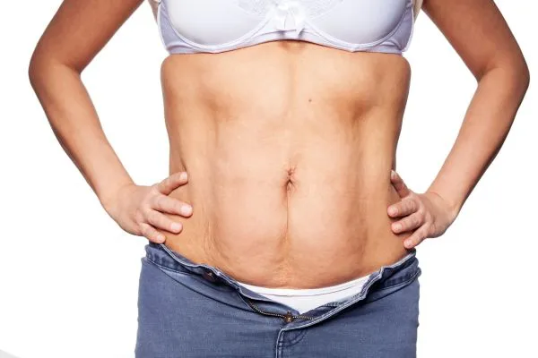 sagging skin on woman's stomach after weight loss injections Uttoxeter