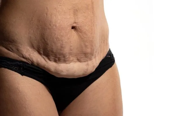 Image of womans stomach after weight loss injections Uttoxeter showing saggy skin