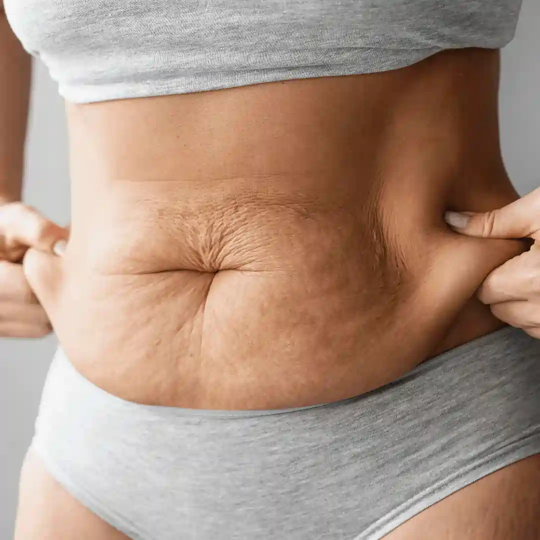 Is It Normal to Have Loose Skin After Pregnancy Uttoxeter?