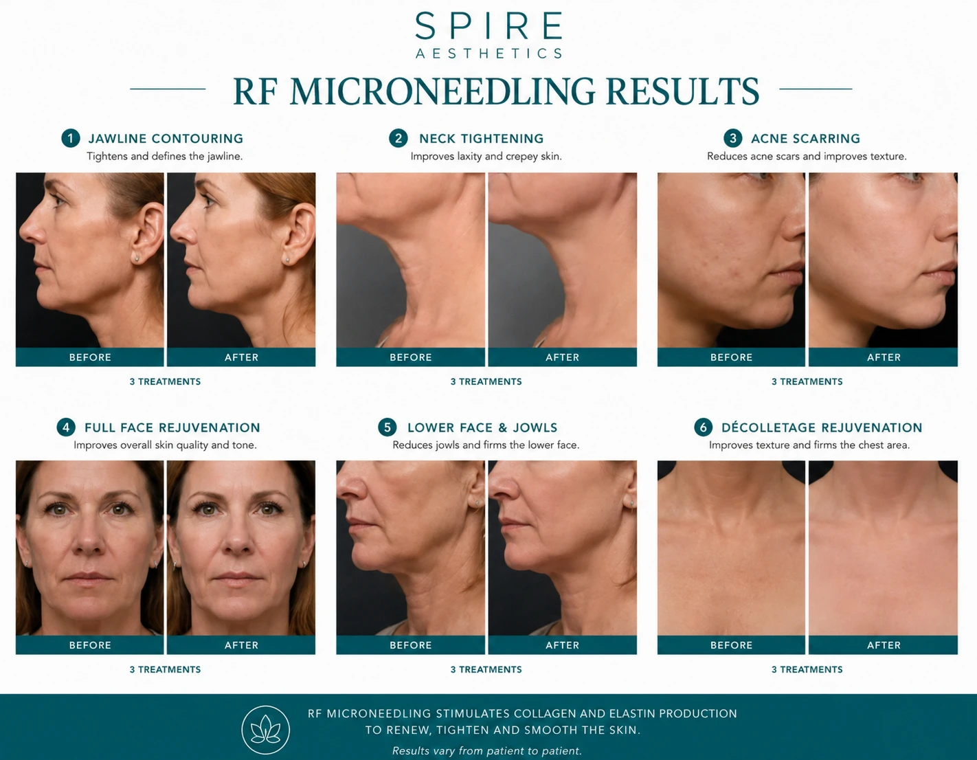 RF Microneedling Skin tightening Uttoxeter results