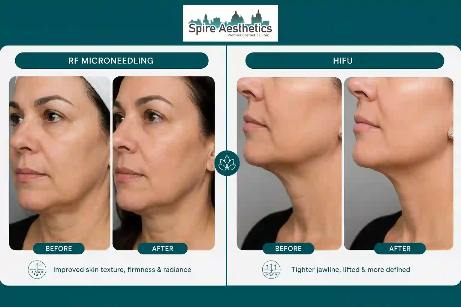 Can RF Microneedling and HIFU Be Combined Uttoxeter?