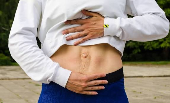 When Could Diastasis Recti Be the Missing Piece of the Puzzle Uttoxeter?
