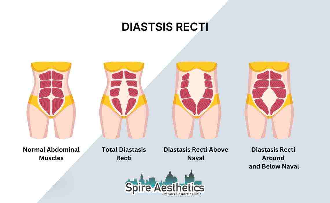 Is Non-Surgical Diastasis Recti Treatment Right for You? Common Concerns Answered Uttoxeter